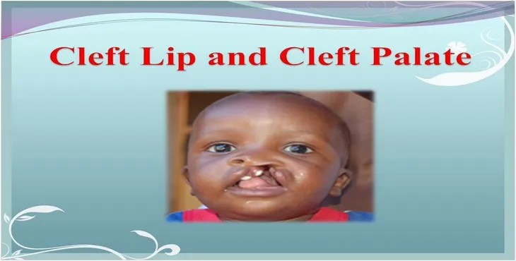 دانلود پاورپوینت شکاف کام و لب