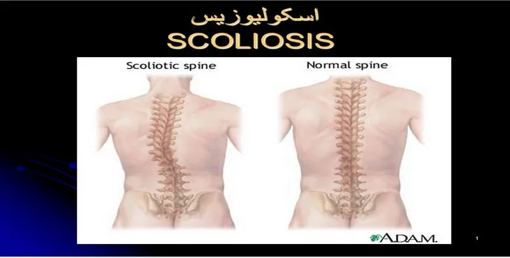 دانلود پاورپوینت اسکولیوزیس